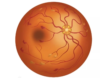 视网膜是“网”还是“膜”？它脱离了会瞎吗？
