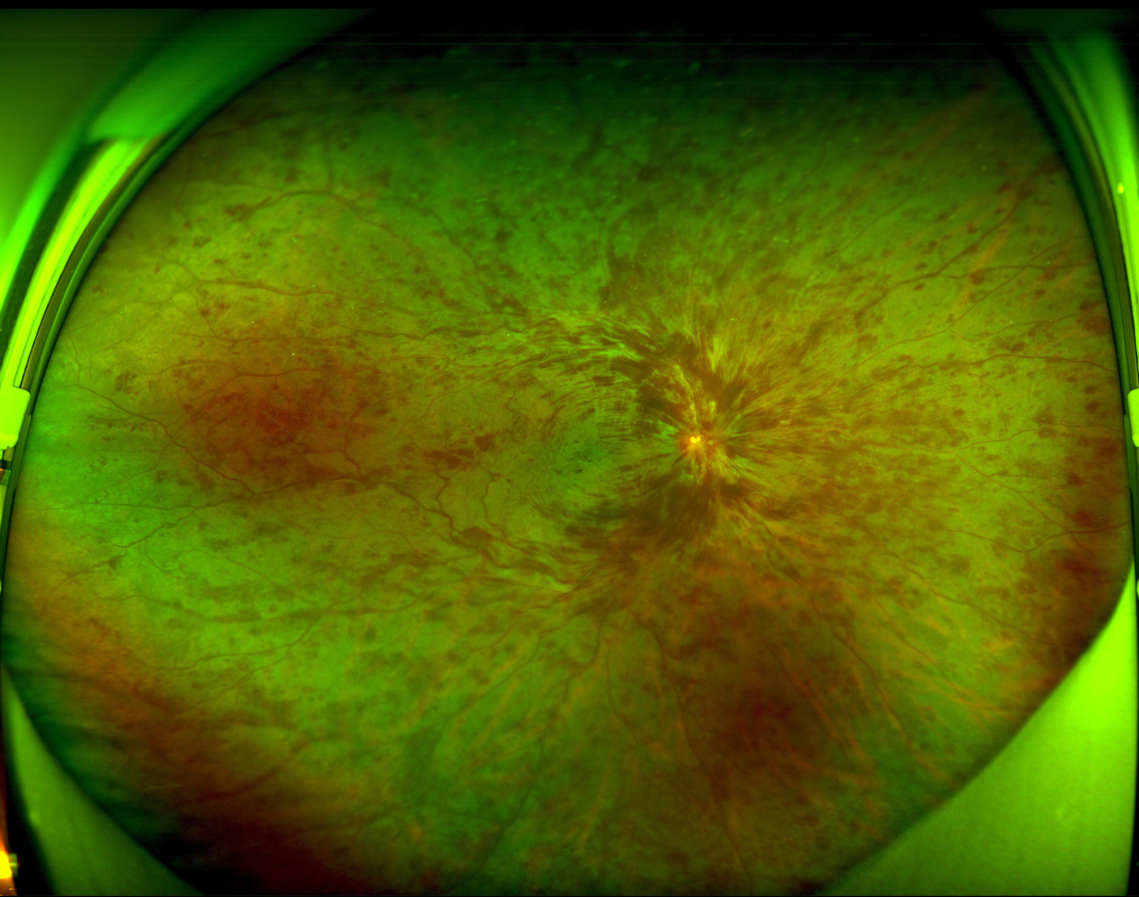 视网膜中央静脉阻塞图片