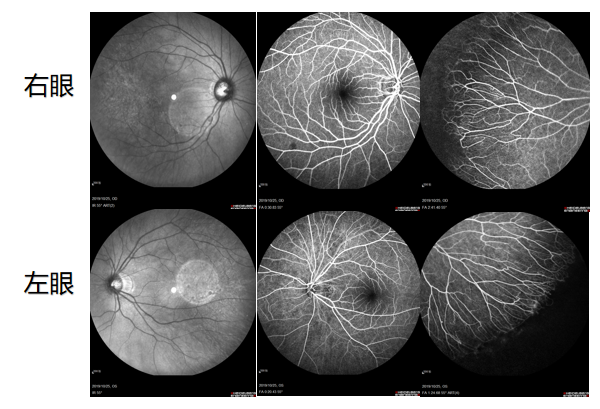 盛迅伦—遗传性眼病病例分析系列-03——早发性高度近视(图4)